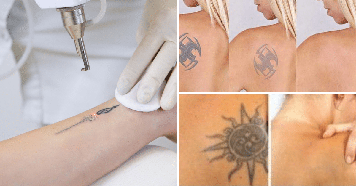 Remover Tatuagem do Corpo